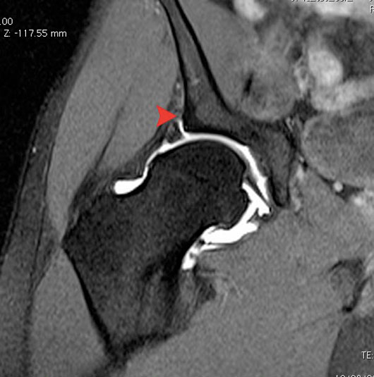 hip MRI - Labral tears