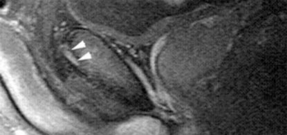 Oblique view at the level of the bladder and pubic symphysis