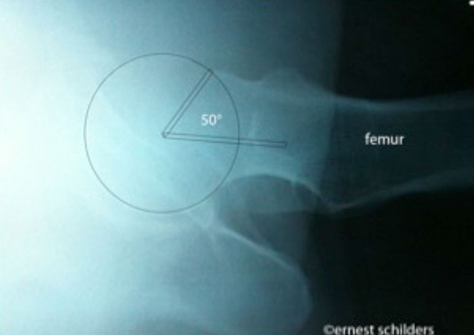 postoperative X ray of the hip following a cam resection