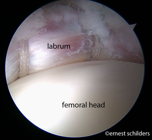 arthroscopic labral repair sitting over femoral head to work as a suction seal