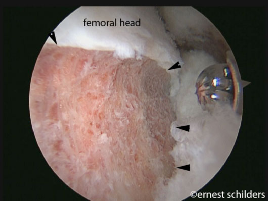 FAI Surgery - femoral neck osteoplasty