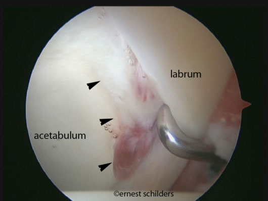 arthroscopic labral detachment