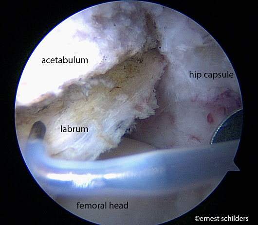 Pincer resection/ acetabular rimrecession - labral detachment