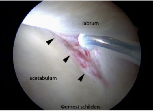 separation of the articular cartilage and the labrum - labral detachment