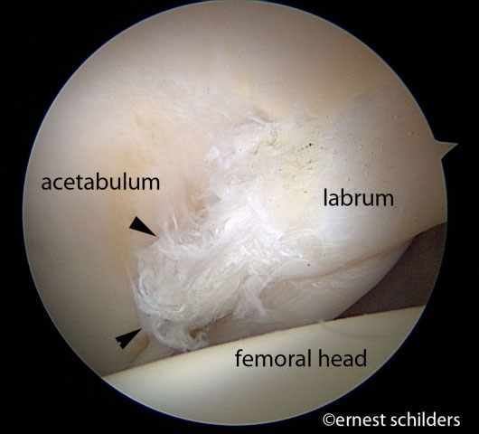 arthroscopic labral flap tear