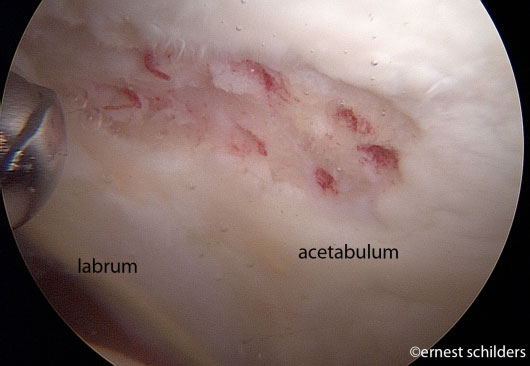 microfracture holes