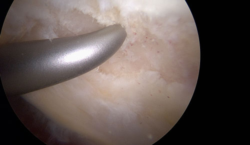 Articular Cartilage Repair Techniques - microfracture