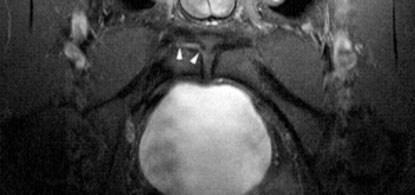  MRI protocol is used to investigate adductor injury