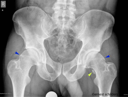 pelvic xray