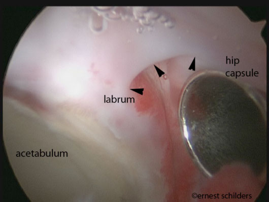 Revision Hip Arthroscopy - scar tissue labrum capsule