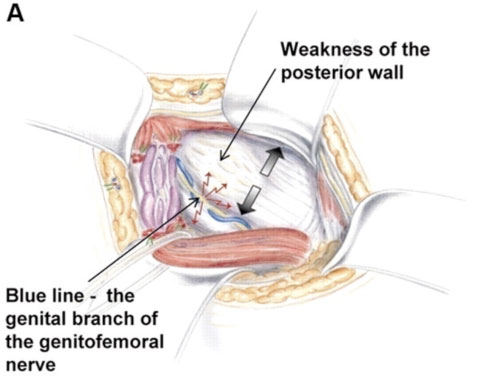 Sportsman Hernia