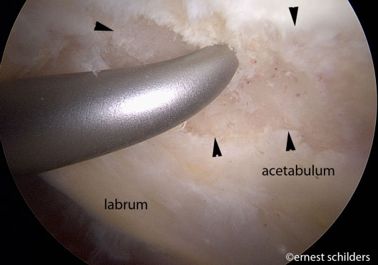microfracture technique - subchondral bone exposed