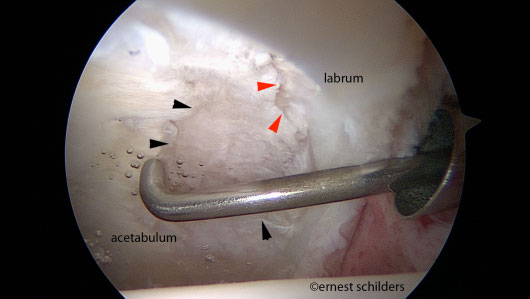 subchondral bone exposed.