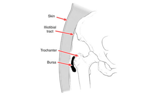 Trochanteric Bursitis