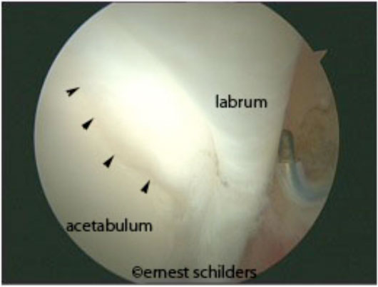 wave sign articular cartilage