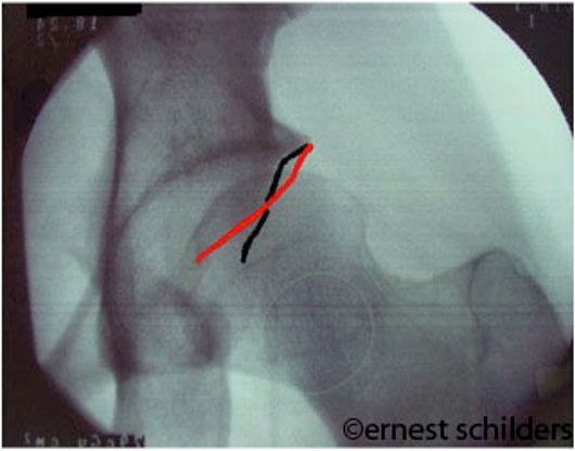 pincer deformity is trimmed with a high speed burr - xray cross over signs