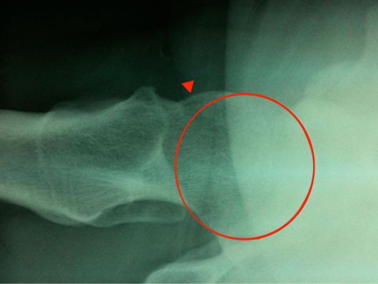 Hip X-ray