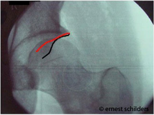 hip X ray demonstrating the cross over sign - xray resected anterior